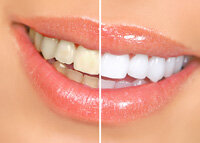 before and after results teeth whitening in Fairfield, CA